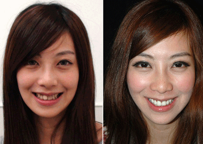 成人传统整牙视频