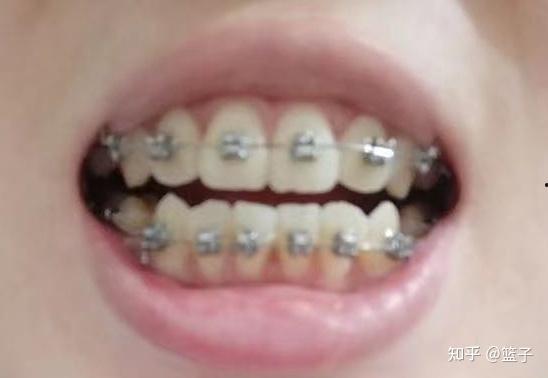 成人牙齿整形视频大全